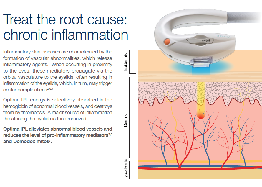 Intense Pulse Light Therapy Kumar Eye Institute